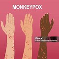 Mpox Hand Cartoon