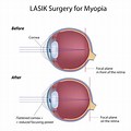 Myopia Eye Surgery