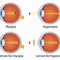 Myopia and Hyperopia in Different Eyes