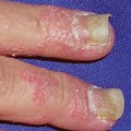 Nails Psoriatic Arthritis Rash