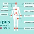 Neurological Lupus Symptoms