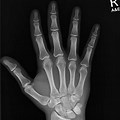 Normal Hand X-ray