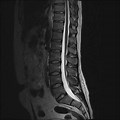 Normal MRI Lumbar Spine