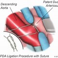PDA Ligation Surgery