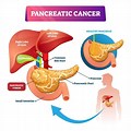 Pancreatic Cancer Tumor Removal