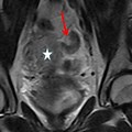 Pelvic MRI Pregnancy Tubal Ectopic