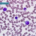 Plasma B Cells Blood Smear