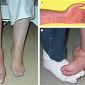 RSD in Left Foot and Ankle