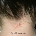 Rash On Neck Body Lice