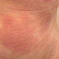 Red Mark On Skin Lymphoma