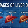S3 S4 Liver Disease