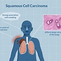 Squamous Cell Carcinoma Lung Cancer