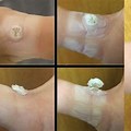 Stages of Common Wart Removal