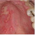 Viral Infection in Mouth