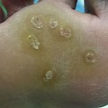 Water Warts On Foot