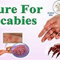 What Happens After Scabies Treatment