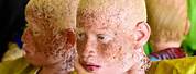 Albino People with Skin Cancer