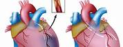 Coronary Bypass Patient Recovery