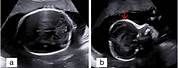 Craniosynostosis Fetal Ultrasound