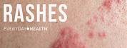 Different Types of Rashes On Skin