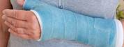 Fiberglass Broken Knee Cast