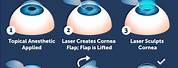 Lasik Laser Eye Surgery