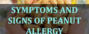 Peanut Allergy HD Images