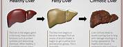 Reversing Alcoholic Fatty Liver Disease