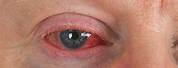 Syphilis Eye Infection