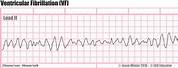 Ventricular Fibrillation ECG