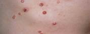 Viral Skin Infections Molluscum Contagiosum