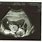 15 Week Twin Ultrasound