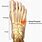 5th Metatarsal Stress Fracture