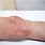Acrodermatitis in Adults