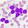 Acute Myeloid Leukemia Cells