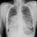 Adenocarcinoma Lung X-ray