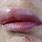 Allergic Lips
