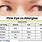 Allergy Pink Eye Symptoms
