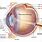 Anterior Cavity Eye