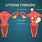 Anterior Fundal Fibroid