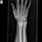 Arm Bone X-ray
