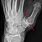 Arthritis Bone Spurs