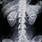Atherosclerosis X-ray