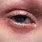 Atopic Dermatitis around Eyes