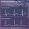 Atrial Fibrillation EKG vs Normal