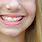 Braces with Clear Bands