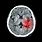Brain Damage CT Scan