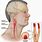 Bulging Carotid Artery in Neck