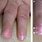 Cirrhosis Nails