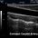 Common Carotid Artery Ultrasound